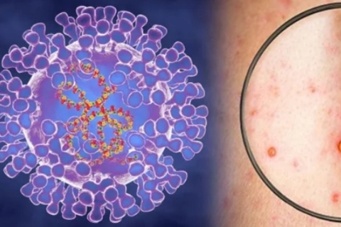Monkeypox unlikely to spread to the community in Vietnam