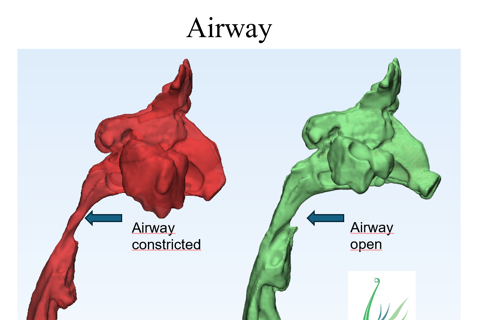 Snoring and mouth opening/breathing during sleep can be signs of severe sleep apnea